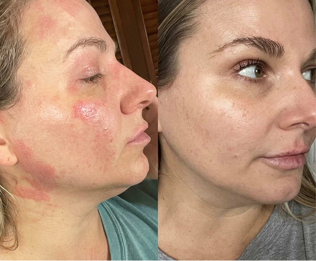 Results after 30 days